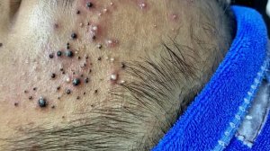 Удаление черных точек в Sac Dep Spa