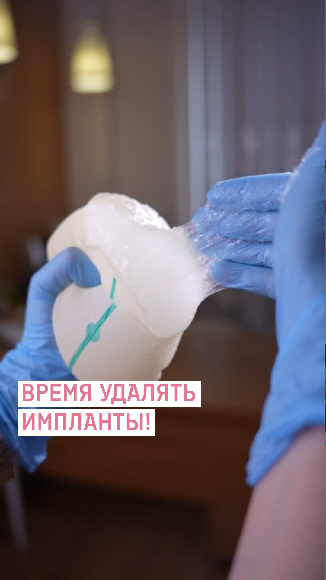 Удаление силиконовых имплантов - новый тренд в пластической хирургии / Евлахова Н.А.