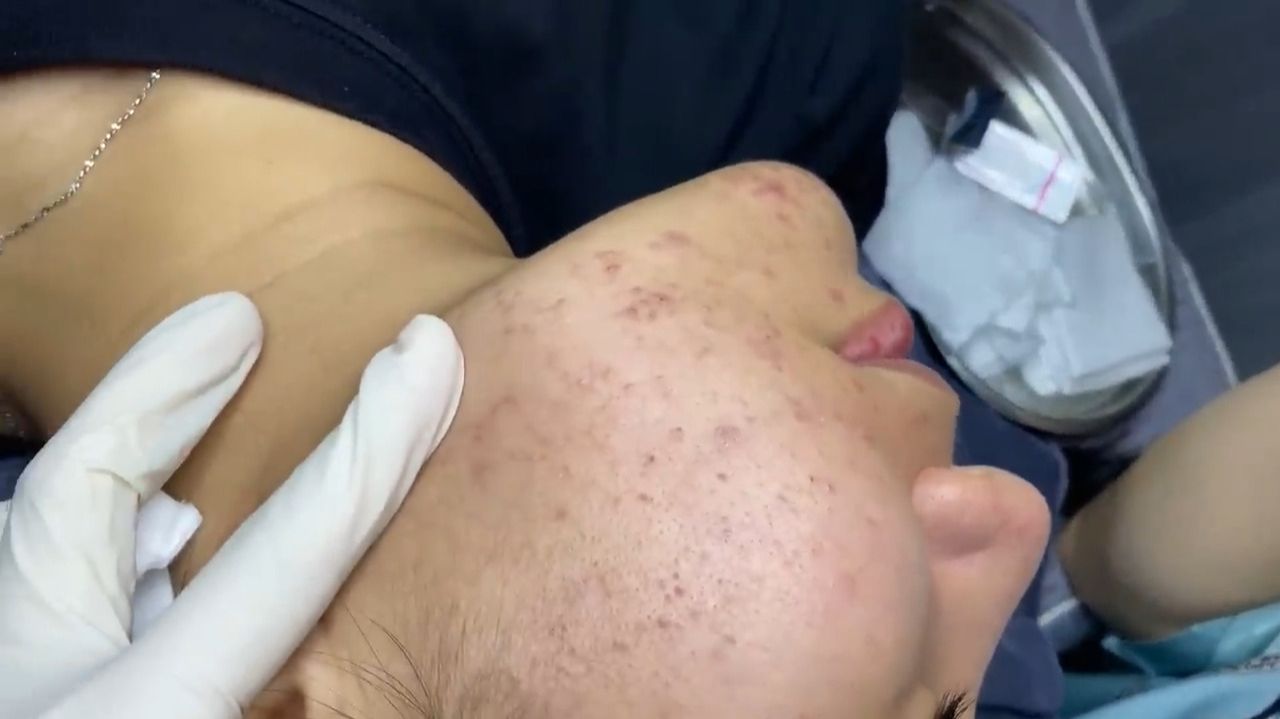 Acne Collection • A041 • Архив SacDepSpa • АСМР