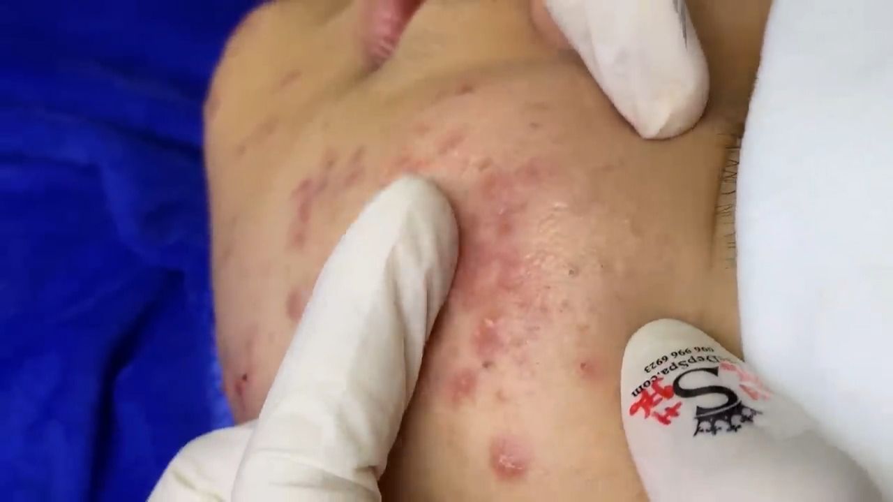 Acne Collection • A043 • Архив SacDepSpa • АСМР