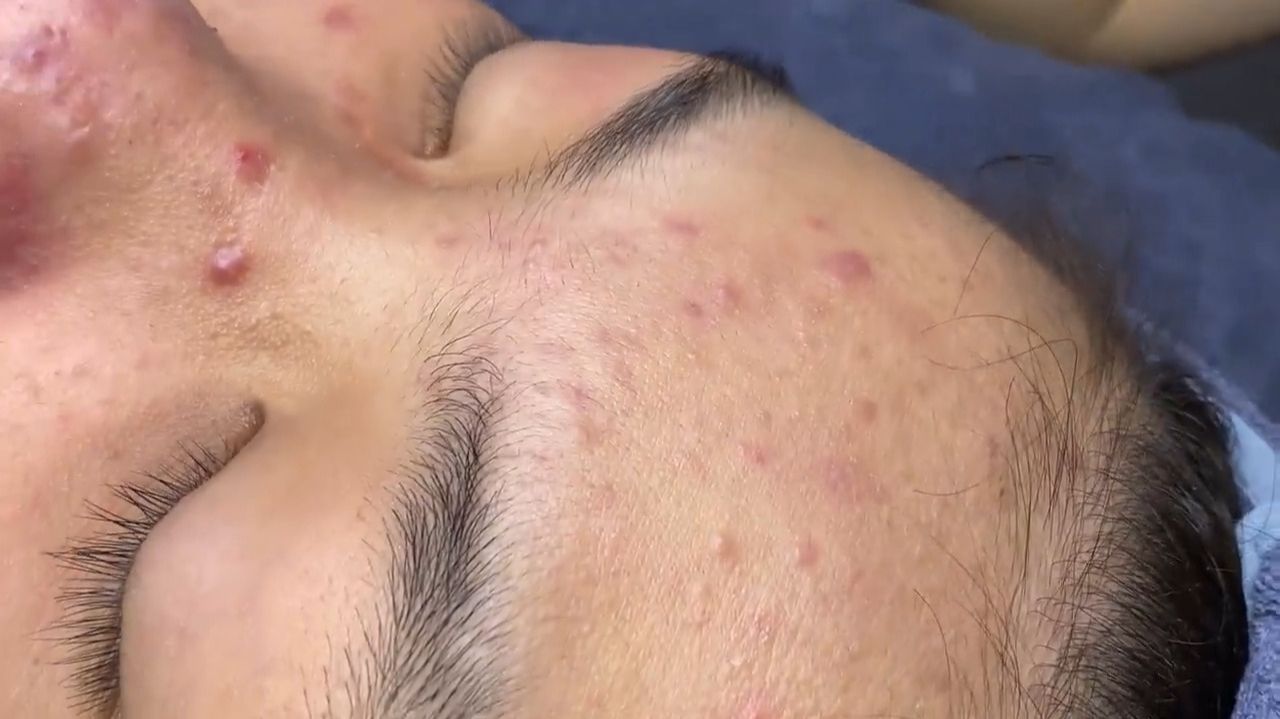 400  Acne collection  АСМР  Relax Spa