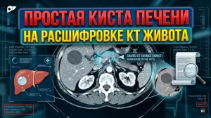 Простая КИСТА ПЕЧЕНИ и ПЕРЕГИБ желчного пузыря на РАСШИФРОВКЕ КТ брюшной полости (второе мнение КТ)