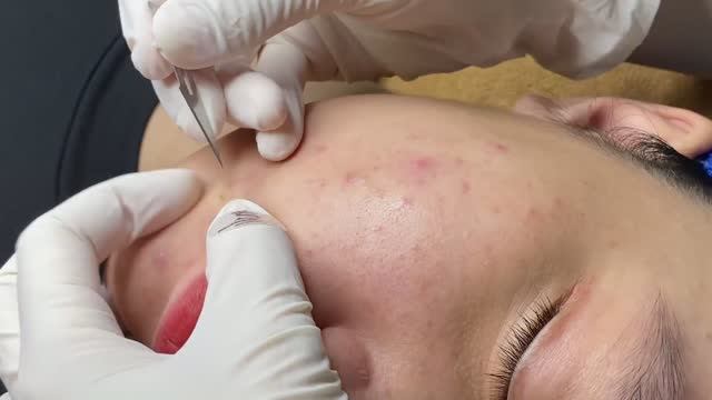 Комплексная чистка кожи от акне и чёрных точек