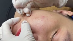 Комплексная чистка кожи от акне и чёрных точек