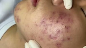 Чистка лица от прыщей – эффективно и быстро
