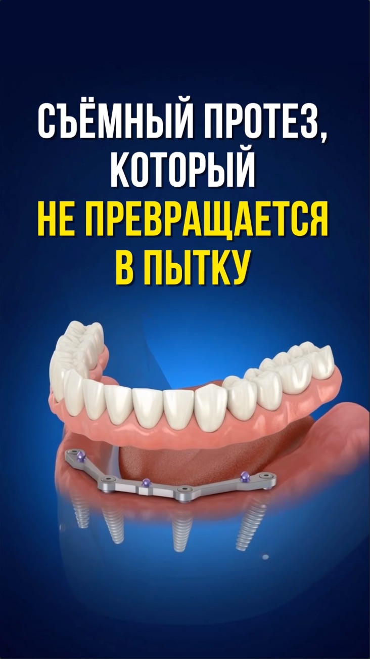 Условно-съёмный протез: как он фиксируется на имплантах. 2 или 4 импланта. кнопки, замки или балка