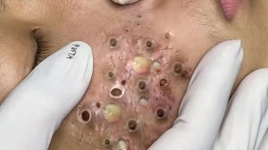 Экстремальное удаление черных точек. Удовлетворение и релакс.