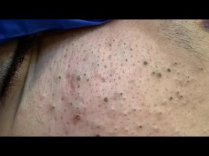 Идеальный уход за лицом: чёрные точки и прыщи — прочь!