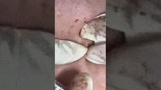 Избавляюсь от 1001 подкожного прыща...