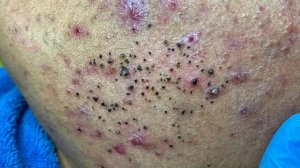 Удаление черных точек с Sac Dep Spa