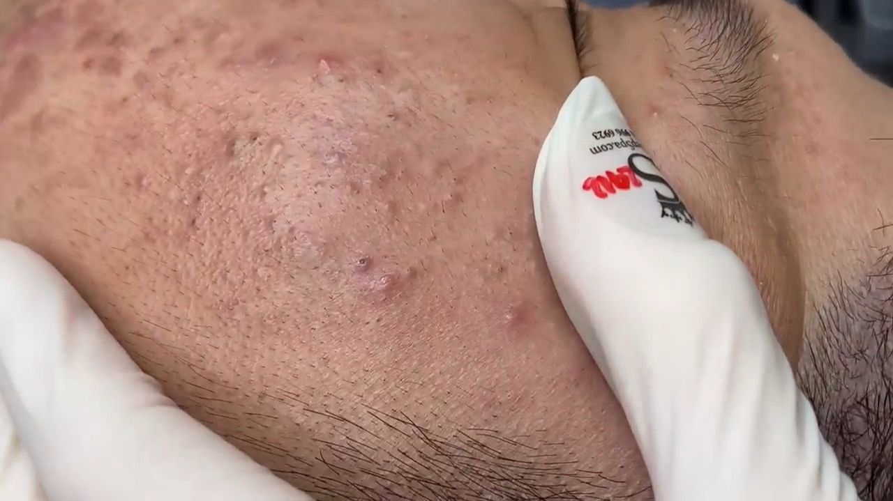 402 • Acne Collection • АСМР • Relax Spa