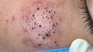 Удаление черных точек в Sac Dep Spa