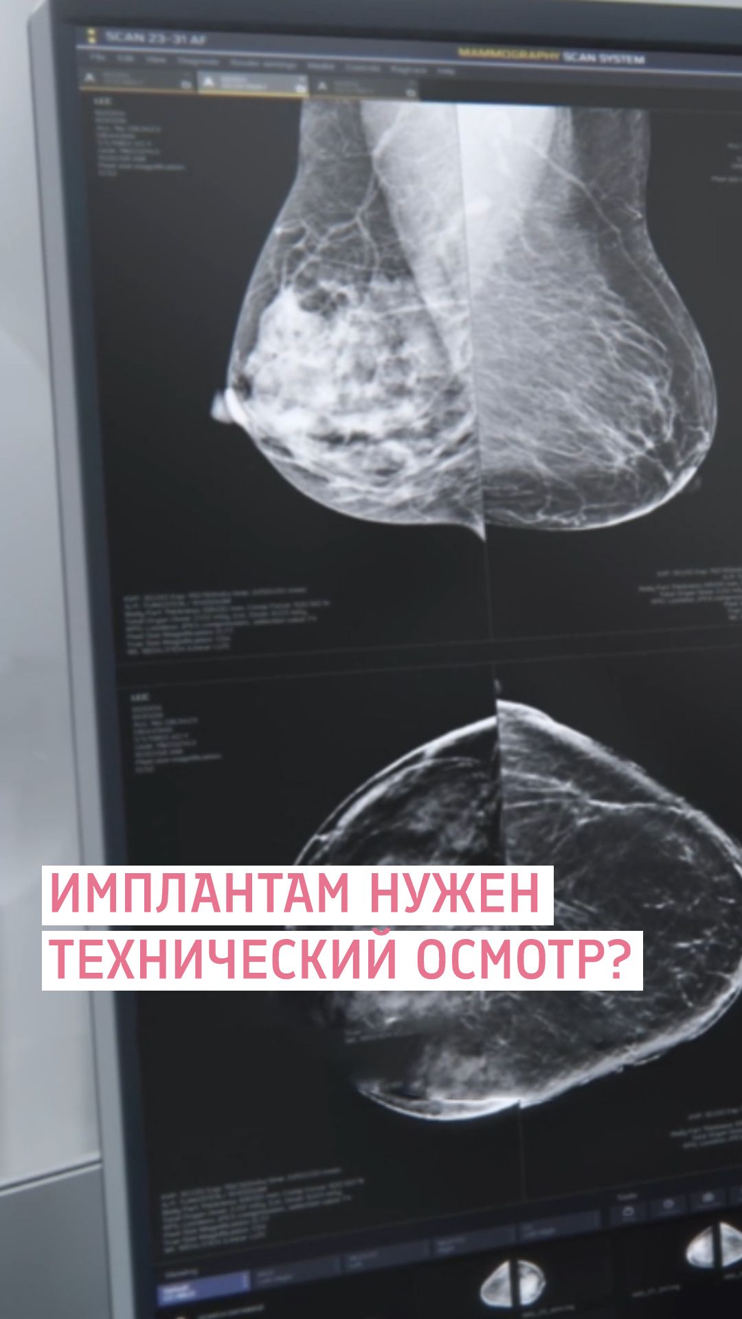 Почему импланты - не лучший способ увеличить грудь? Евлахова Наталья Алексеевна Пластический хирург