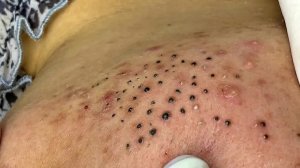 Удаление черных точек в Sac Dep Spa