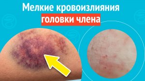 😢 Мелкие кровоизлияния головки члена. Клинический случай №1636