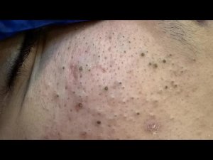 Deep Pore Cleansing and Blackhead Removal with Tweezers - Satisfying and Close-Up | Korean Skincare