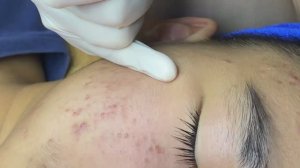 Процедура очищения кожи от акне – результат с первого раза