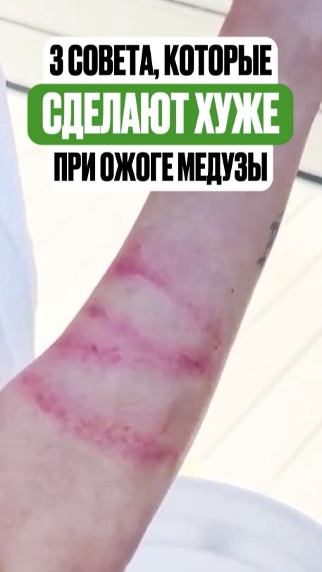Эти советы при ожогах медузы сделают только хуже
