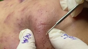 Чистка лица от акне для подростков и взрослых