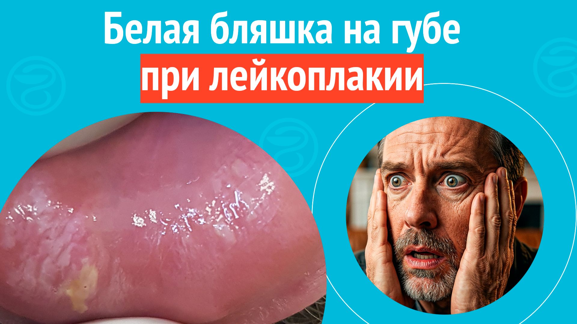 😟 Белая бляшка на губе при лейкоплакии. Клинический случай № 1828