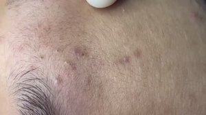 Удаление закрытых комедонов и акне