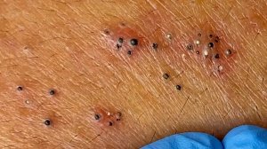 Удаление черных точек в Sac Dep Spa