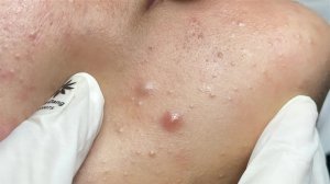 Расслабляющее удаление акне от LinhMyDang Spa