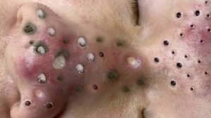 Выдавливание прыщей. Отличное качеств НОВОЕ