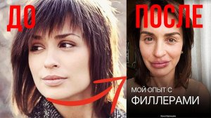 Жертва пластики: Стало известно как филлеры испортили лицо Ирины Муромцевой