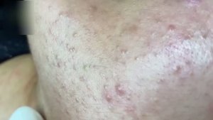 Удаление прыщей на всех зонах лица