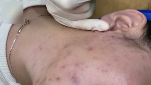 Удаление акне и комедонов – гладкая кожа