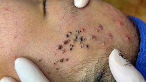 Удаление черных точек в Sac Dep Spa