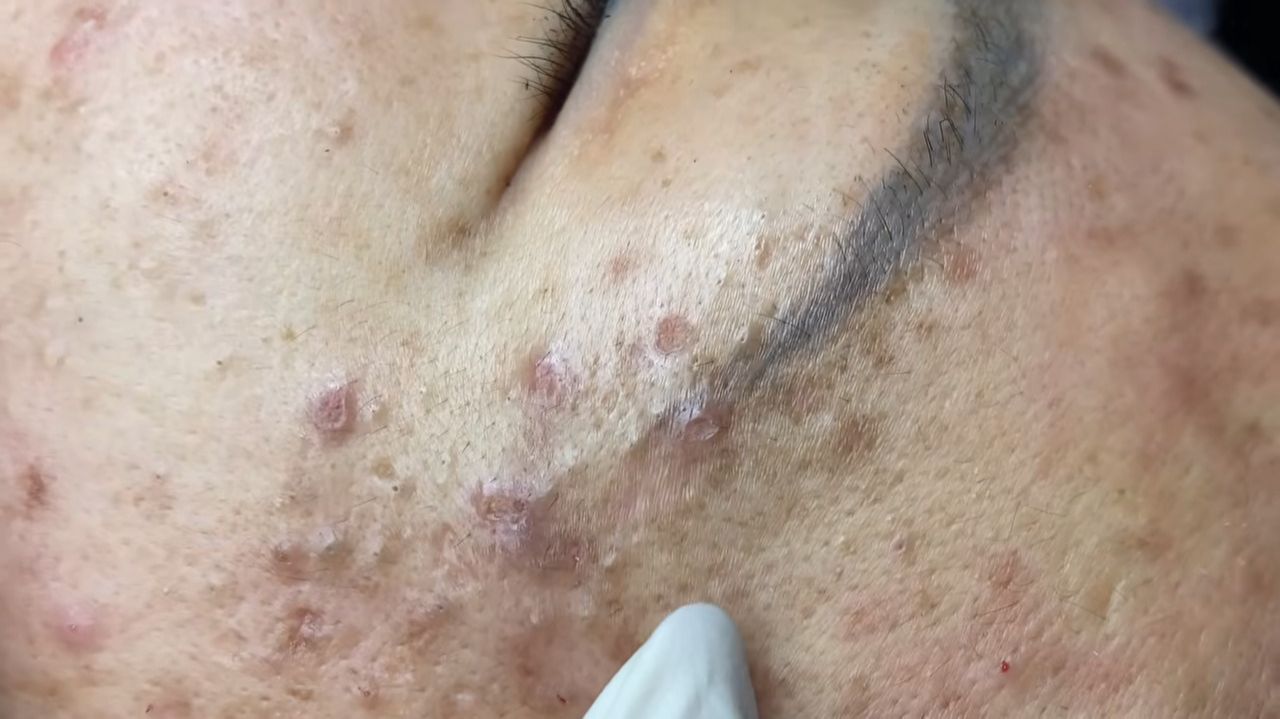 405  Acne collection  АСМР  Relax Spa