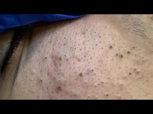Satisfying Blackhead And Whitehead Removal - So Deep, So Clean!