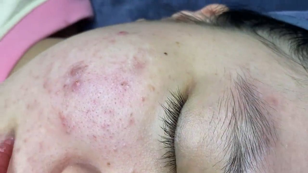 Acne Collection • A048 • Архив SacDepSpa • АСМР