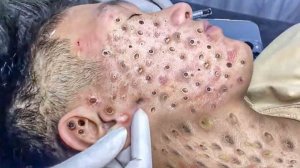 Выдавливание прыщей. Отличное качеств НОВОЕ