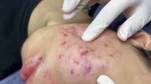 Чистая кожа без акне – Удаление комедонов