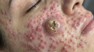 Выдавливание прыщей. Отличное качеств НОВОЕ