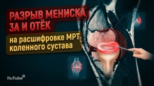 ОТЁК коленного сустава с РАЗРЫВОМ МЕНИСКА 3 степени по stoller на РАСШИФРОВКЕ МРТ коленного сустава