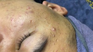 385 • Acne collection • АСМР • Relax Spa
