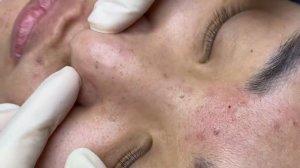 387 • Acne collection • АСМР • Relax Spa