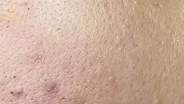 Удаление черных точек в Sac Dep Spa
