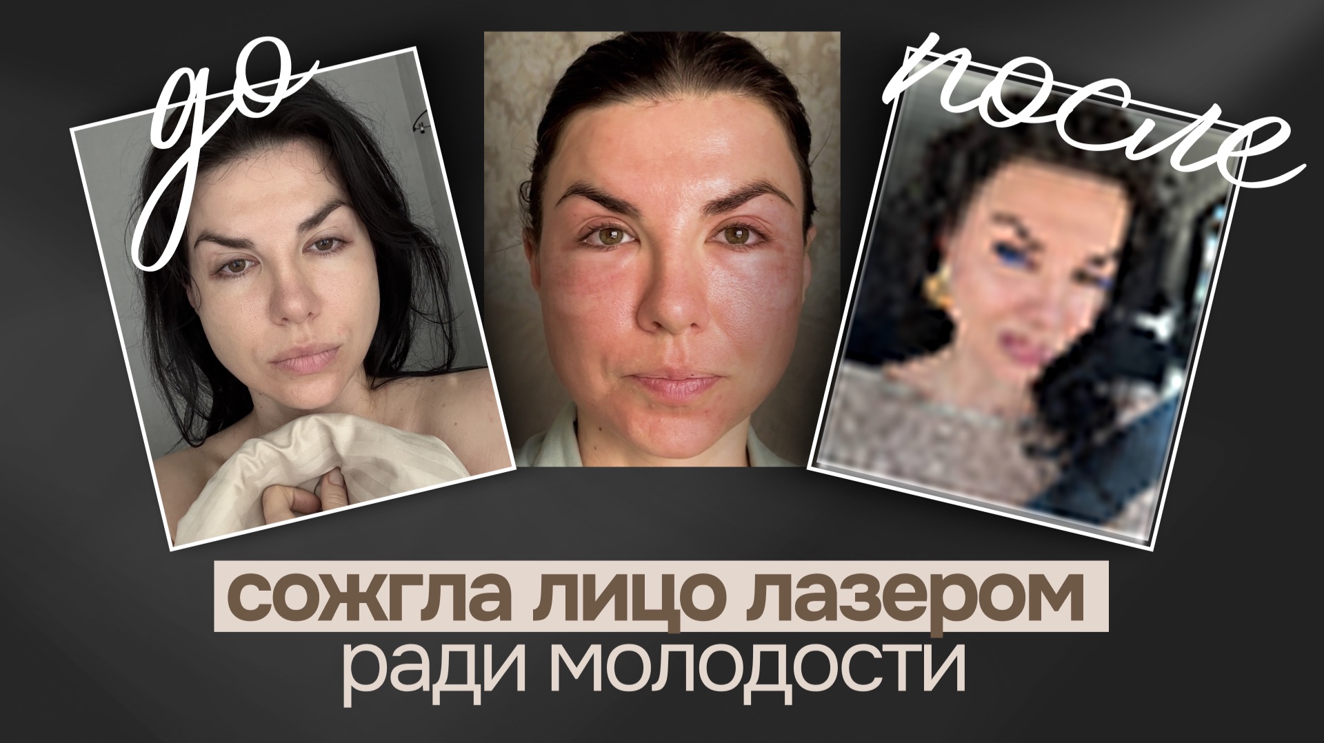 Лазер CO2: как я решилась на травматичные косметологические процедуры и что из этого вышло