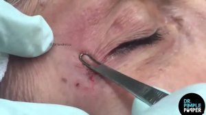 Множественные черные точки под глазами безопасно удалены доктором Прыщ