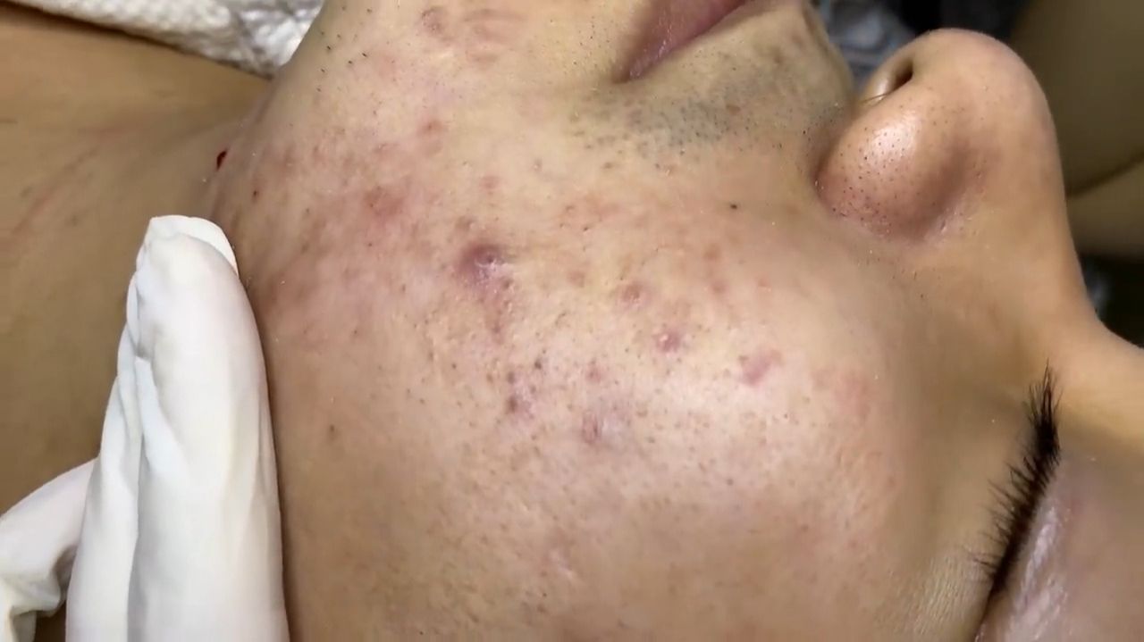 394 • Acne Collection • АСМР • Relax Spa