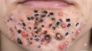Выдавливание прыщей. Отличное качеств НОВОЕ