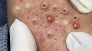 Extreme Blackhead Removal Satisfying Relaxing #1154