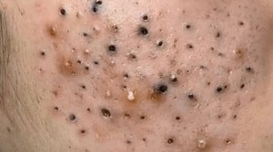 Выдавливание прыщей. НОВОЕ! Угри. Акне. чистка лица