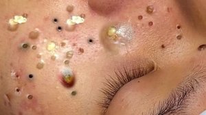 Extreme Blackhead Removal Satisfying Relaxing #1156