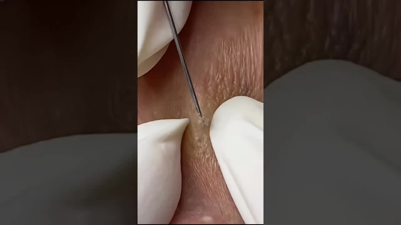Выдавливание прыщей  Расслабляющий ASMR